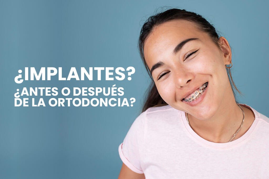 implantes-dentales