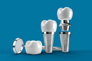 partes-de-los-implantes-dentales